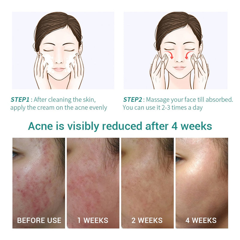 Aloe Acne Treatment Gel Face Cream Serum Anti Acne Scar Cream Shrink Pores Moisturizing Oil Control Soothing Essence Skin Care