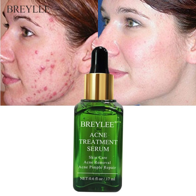 BREYLEE Acne Treatment Serum Face Cream Skin Care Anti Acne Face Essence Removal Spots Pimple Patch Stickers Face Mask Cosmetics