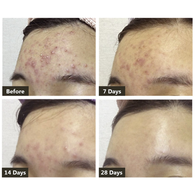 BREYLEE Acne Treatment Serum Face Cream Skin Care Anti Acne Face Essence Removal Spots Pimple Patch Stickers Face Mask Cosmetics